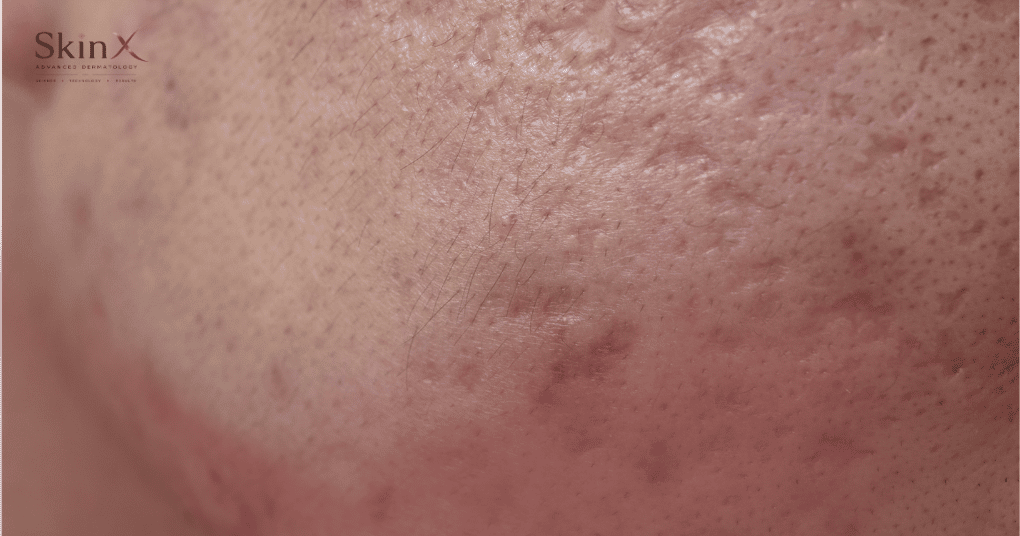 Trị sẹo rỗ bằng laser fractional co2 có hết không